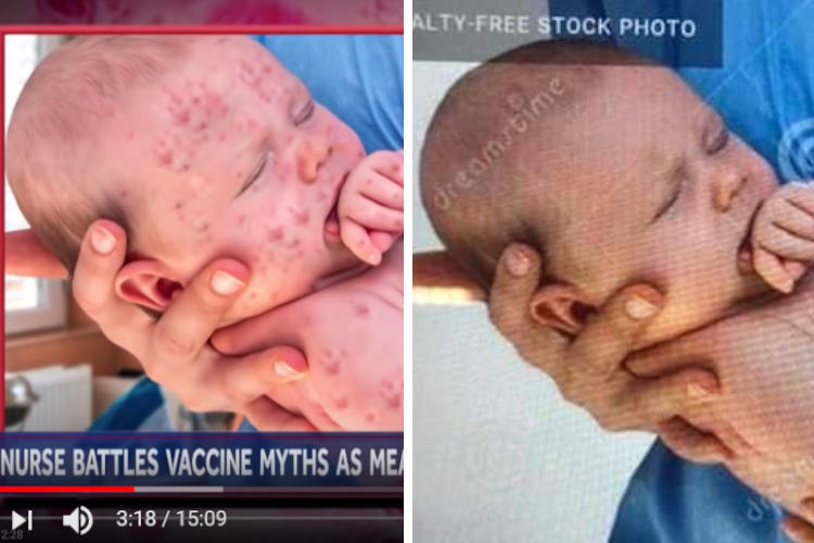 CNN and NBC Caught Faking Photo of Baby with Measles